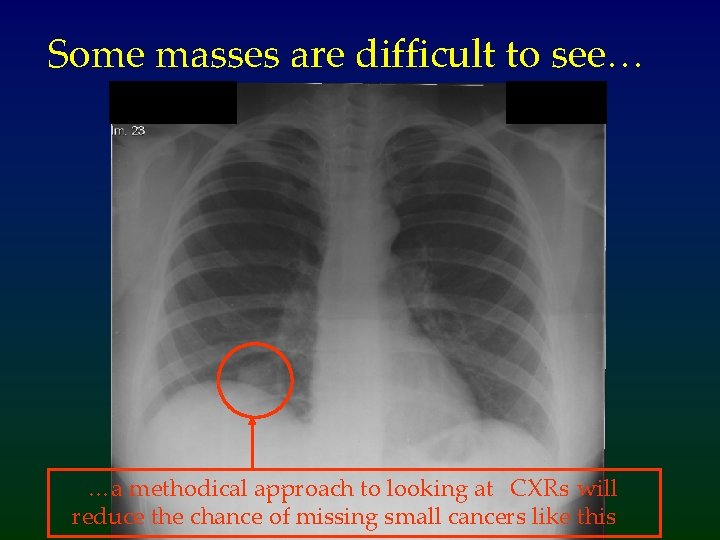 Some masses are difficult to see… …a methodical approach to looking at CXRs will