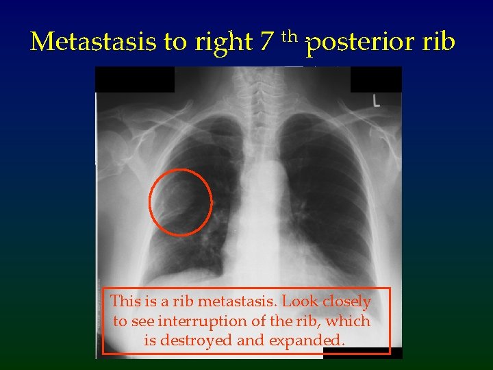 Metastasis to right 7 th posterior rib This is a rib metastasis. Look closely