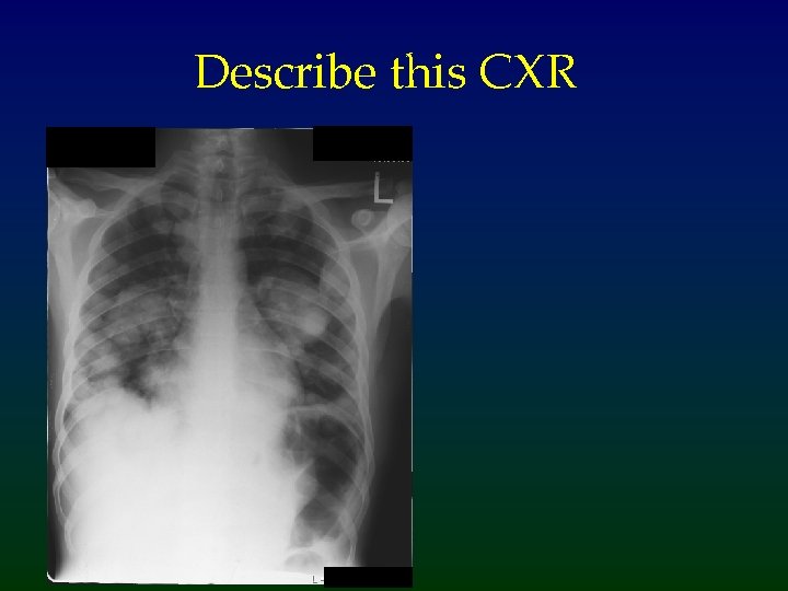 Describe this CXR 