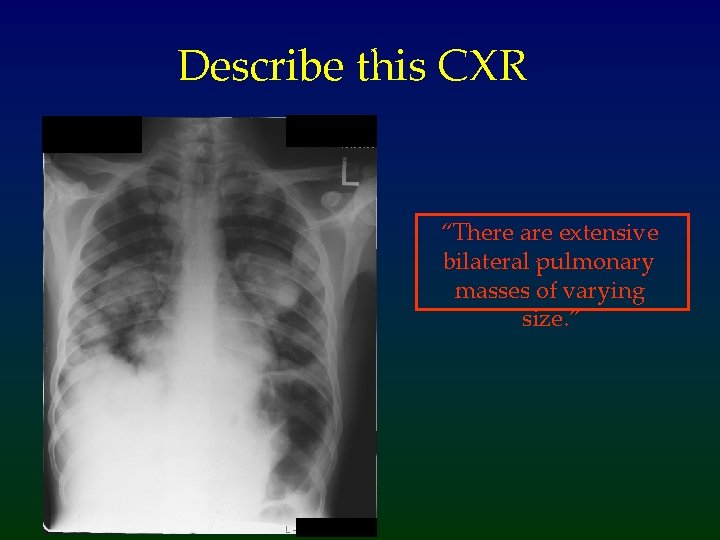 Describe this CXR “There are extensive bilateral pulmonary masses of varying size. ” 