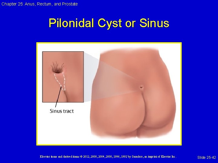 Chapter 25: Anus, Rectum, and Prostate Pilonidal Cyst or Sinus Elsevier items and derived Chapter 25: Anus, Rectum, and Prostate Pilonidal Cyst or Sinus Elsevier items and derived