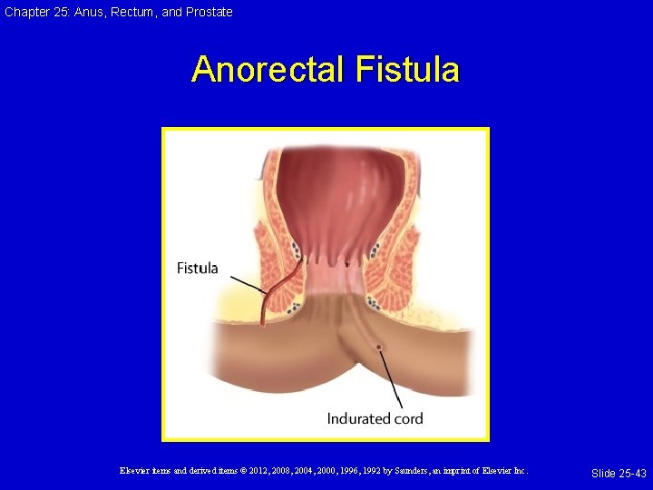 Chapter 25: Anus, Rectum, and Prostate Anorectal Fistula Elsevier items and derived items © Chapter 25: Anus, Rectum, and Prostate Anorectal Fistula Elsevier items and derived items ©