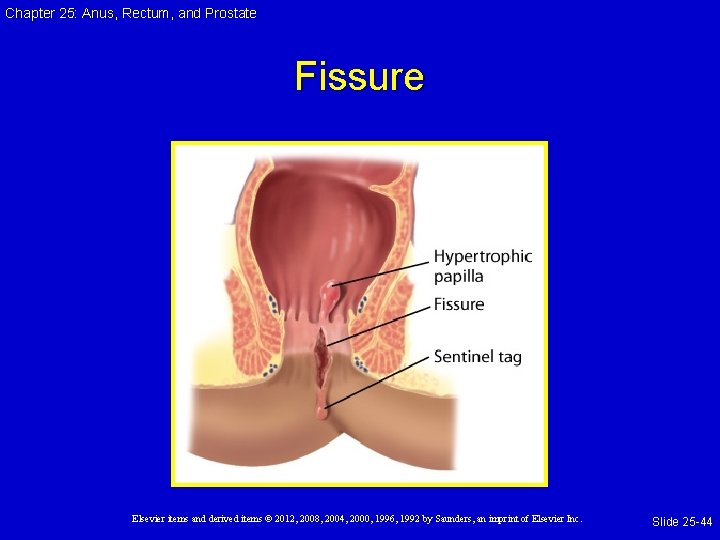Chapter 25: Anus, Rectum, and Prostate Fissure Elsevier items and derived items © 2012, Chapter 25: Anus, Rectum, and Prostate Fissure Elsevier items and derived items © 2012,