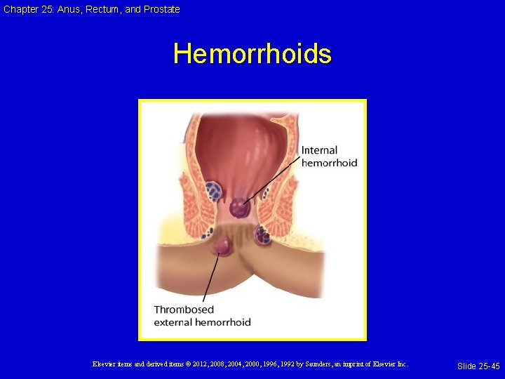 Chapter 25: Anus, Rectum, and Prostate Hemorrhoids Elsevier items and derived items © 2012, Chapter 25: Anus, Rectum, and Prostate Hemorrhoids Elsevier items and derived items © 2012,