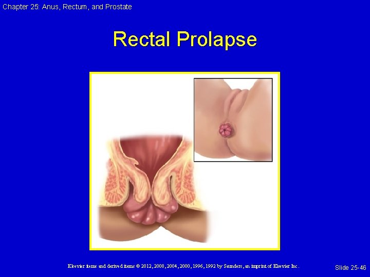 Chapter 25: Anus, Rectum, and Prostate Rectal Prolapse Elsevier items and derived items © Chapter 25: Anus, Rectum, and Prostate Rectal Prolapse Elsevier items and derived items ©