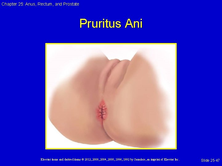 Chapter 25: Anus, Rectum, and Prostate Pruritus Ani Elsevier items and derived items © Chapter 25: Anus, Rectum, and Prostate Pruritus Ani Elsevier items and derived items ©
