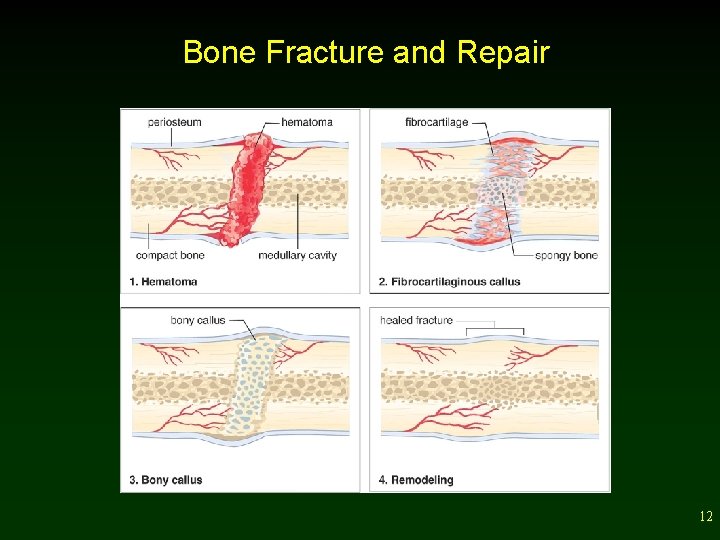Bone Fracture and Repair 12 