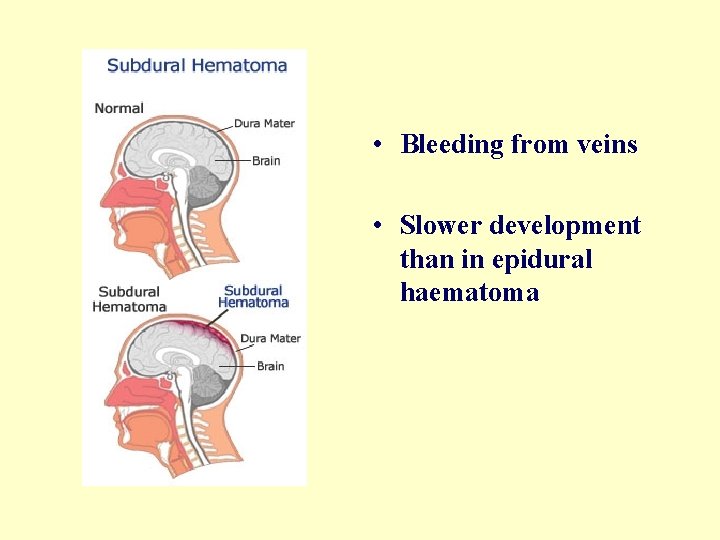  • Bleeding from veins • Slower development than in epidural haematoma 
