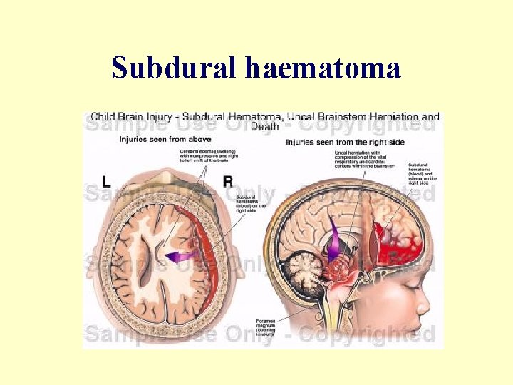 Subdural haematoma 