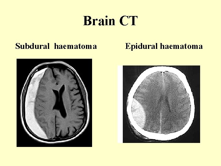 Brain CT Subdural haematoma Epidural haematoma 