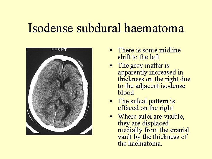 Isodense subdural haematoma • There is some midline shift to the left • The