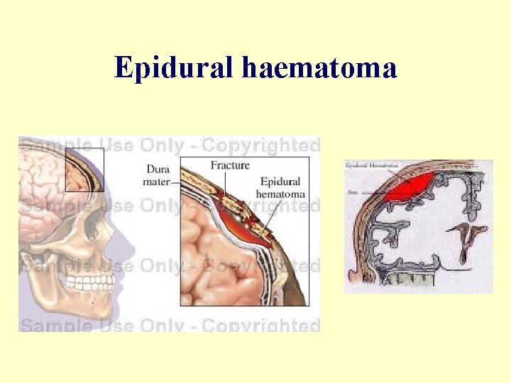 Epidural haematoma 