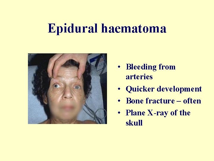 Epidural haematoma • Bleeding from arteries • Quicker development • Bone fracture – often
