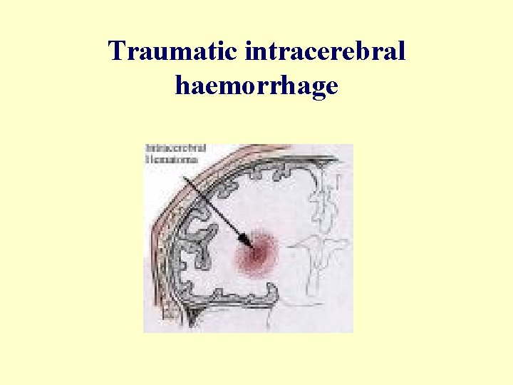 Traumatic intracerebral haemorrhage 