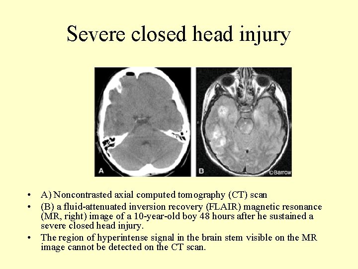 Severe closed head injury • A) Noncontrasted axial computed tomography (CT) scan • (B)