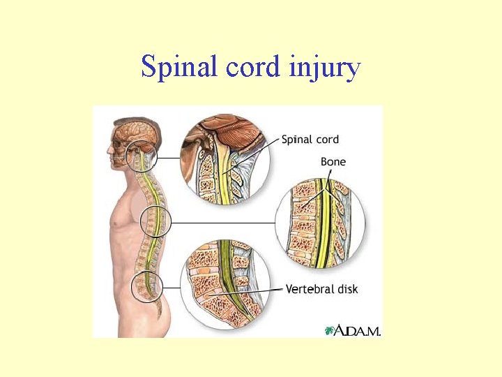 Spinal cord injury 