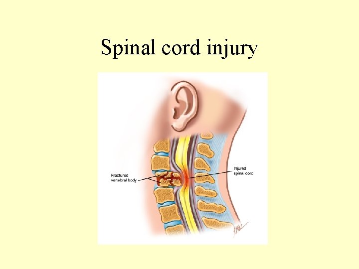 Spinal cord injury 