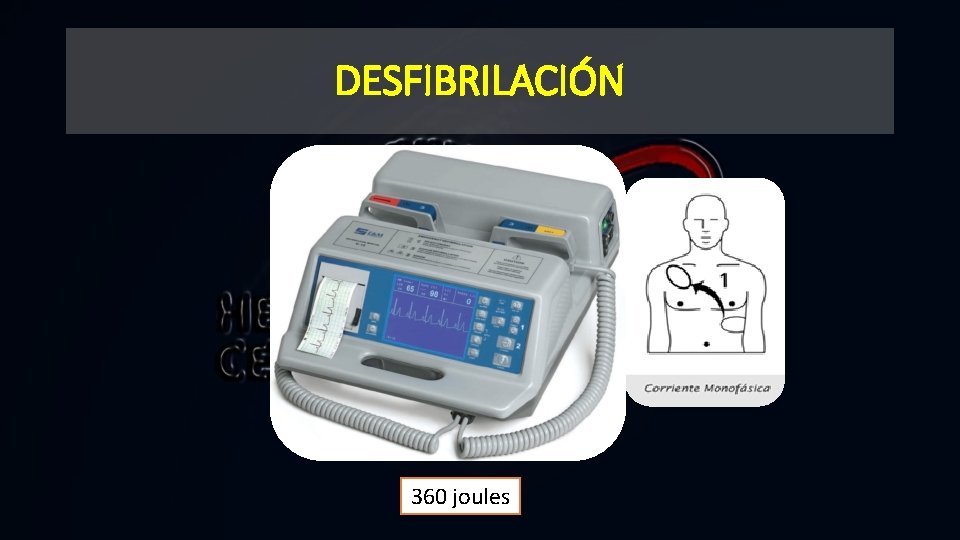 DESFIBRILACIÓN 360 joules 