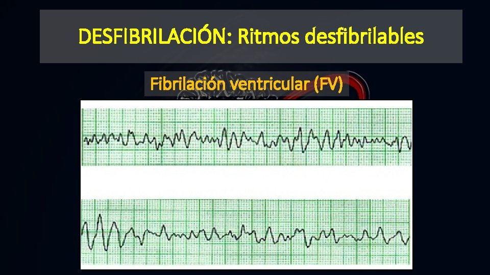 DESFIBRILACIÓN: Ritmos desfibrilables Fibrilación ventricular (FV) 