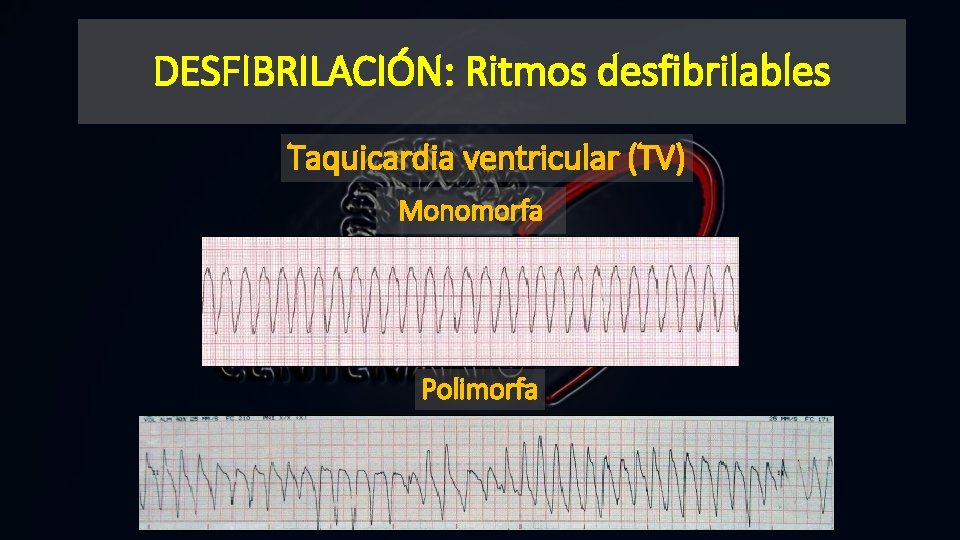DESFIBRILACIÓN: Ritmos desfibrilables Taquicardia ventricular (TV) Monomorfa Polimorfa 