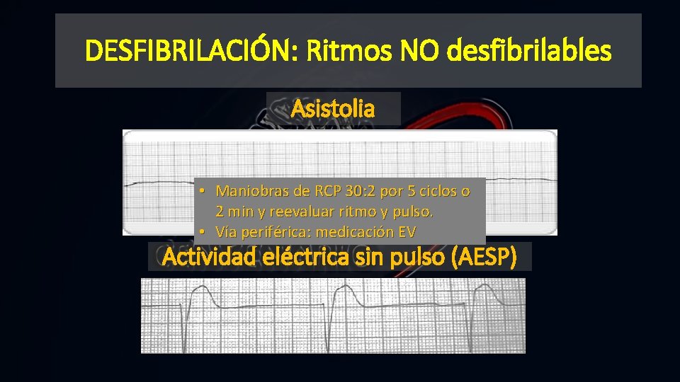 DESFIBRILACIÓN: Ritmos NO desfibrilables Asistolia • Maniobras de RCP 30: 2 por 5 ciclos