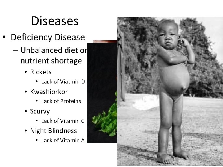 Diseases • Deficiency Disease – Unbalanced diet or nutrient shortage • Rickets • Lack