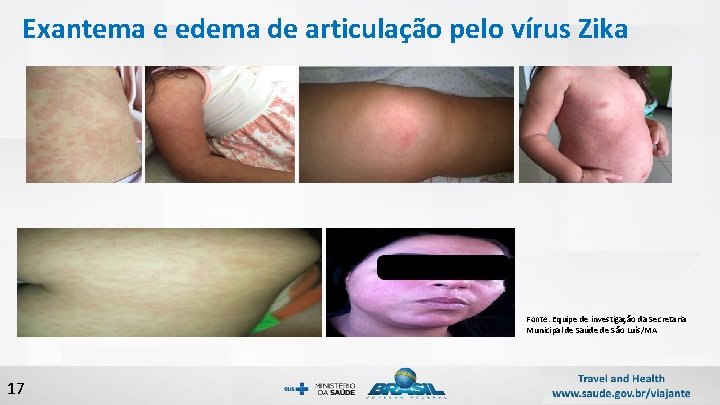 Exantema e edema de articulação pelo vírus Zika Fonte: Equipe de investigação da Secretaria