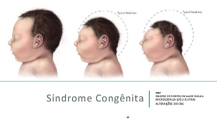 Síndrome Congênita 20 RESP REGISTRO DE EVENTOS EM SAÚDE PÚBLICA MICROCEFALIA E/OU OUTRAS ALTERAÇÕES