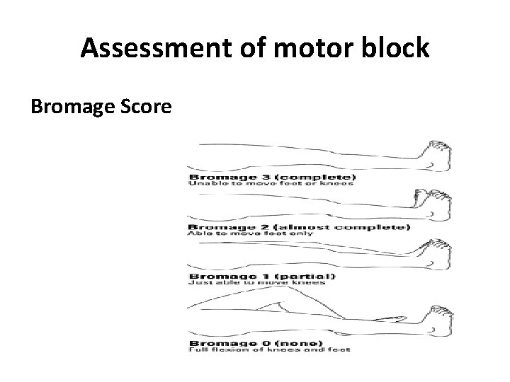 Assessment of motor block Bromage Score 