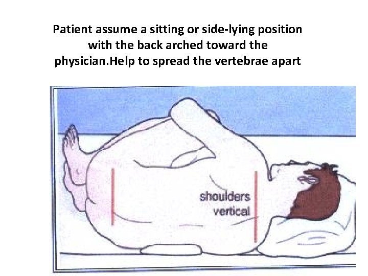 Patient assume a sitting or side-lying position with the back arched toward the physician.