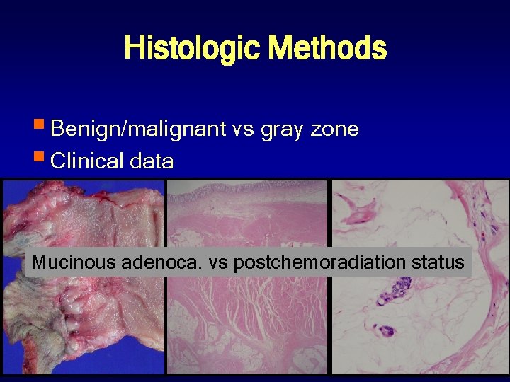 Histologic Methods § Benign/malignant vs gray zone § Clinical data Mucinous adenoca. vs postchemoradiation