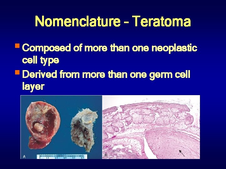 Nomenclature – Teratoma § Composed of more than one neoplastic cell type § Derived