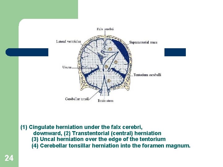 (1) Cingulate herniation under the falx cerebri, downward, (2) Transtentorial (central) herniation (3) Uncal