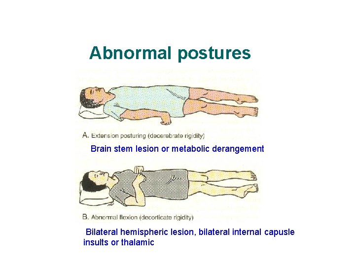 Abnormal postures Brain stem lesion or metabolic derangement 7 Bilateral hemispheric lesion, bilateral internal