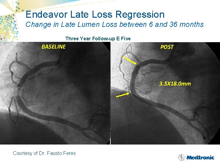 Endeavor Late Loss Regression Change in Late Lumen Loss between 6 and 36 months