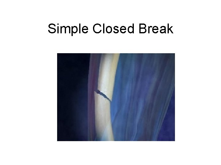Simple Closed Break 