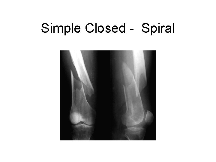 Simple Closed - Spiral 