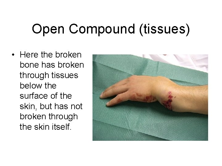 Open Compound (tissues) • Here the broken bone has broken through tissues below the