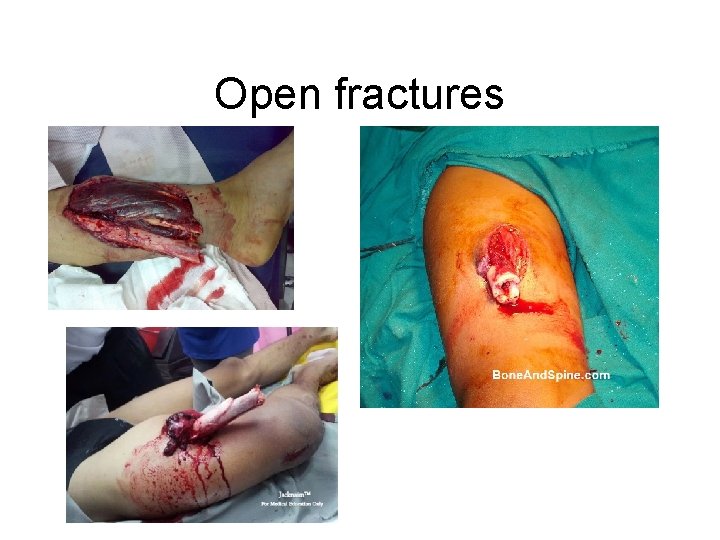 Open fractures 