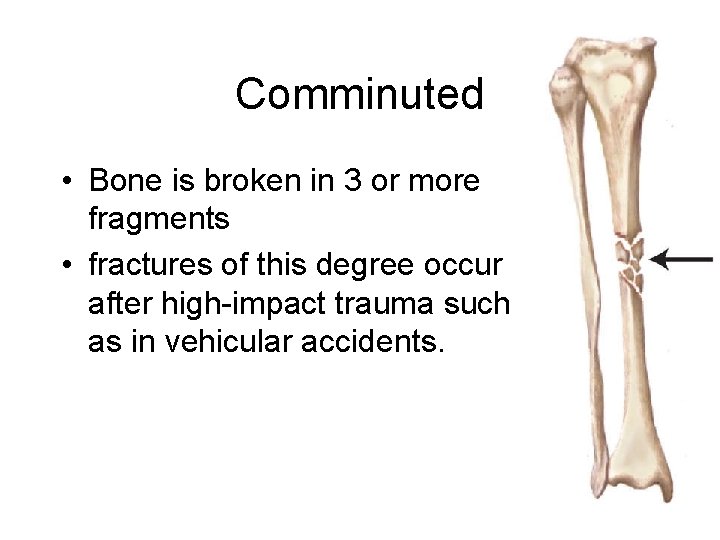 Comminuted • Bone is broken in 3 or more fragments • fractures of this