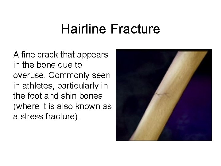 Hairline Fracture A fine crack that appears in the bone due to overuse. Commonly