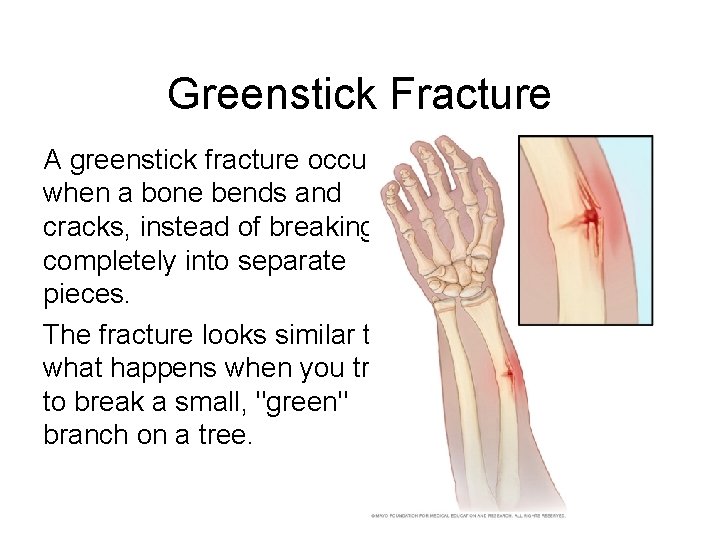 Greenstick Fracture A greenstick fracture occurs when a bone bends and cracks, instead of