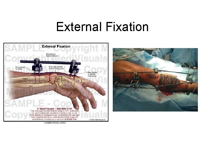 External Fixation 