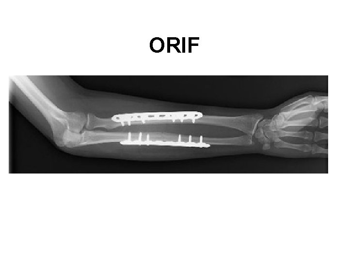 ORIF 