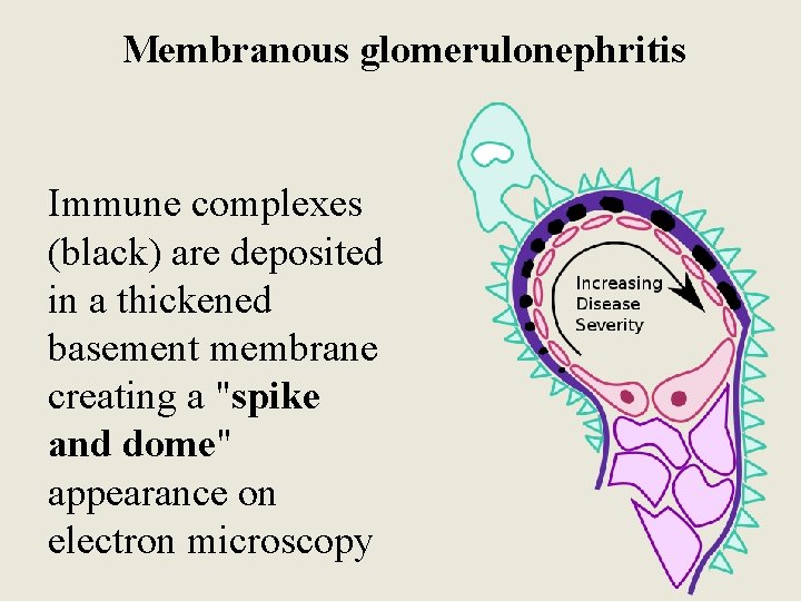 Membranous glomerulonephritis Immune complexes (black) are deposited in a thickened basement membrane creating a