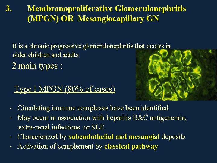 3. Membranoproliferative Glomerulonephritis (MPGN) OR Mesangiocapillary GN It is a chronic progressive glomerulonephritis that