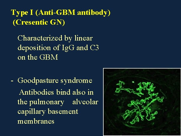 Type I (Anti-GBM antibody) (Cresentic GN) Characterized by linear deposition of Ig. G and