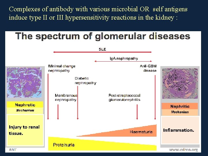 Complexes of antibody with various microbial OR self antigens induce type II or III