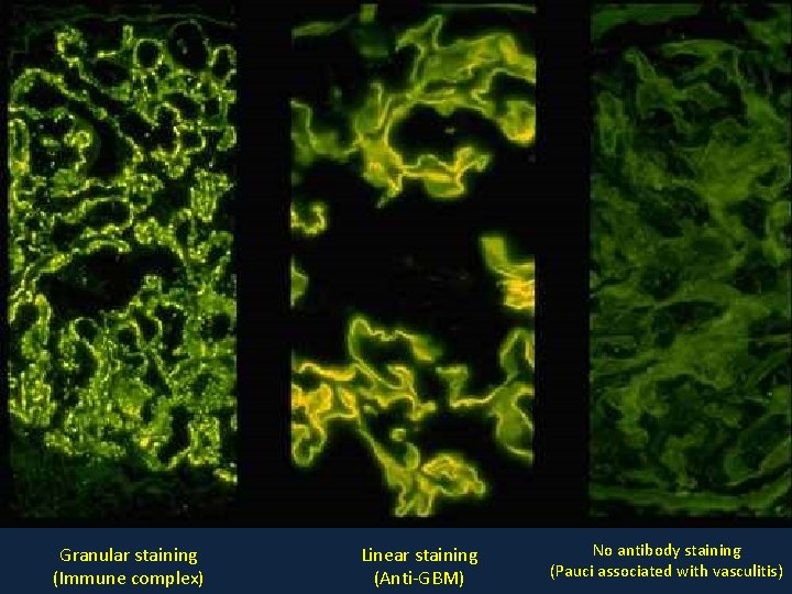 Granular staining (Immune complex) Linear staining (Anti-GBM) No antibody staining (Pauci associated with vasculitis)
