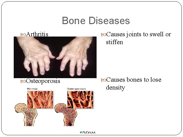 Bone Diseases Arthritis Causes joints to swell or stiffen Osteoporosis Causes bones to lose